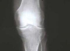 Douleurs inflammatoires des 2 genoux, évoluant depuis 5 ans.
Devenant actuellement plus mécaniques.
Cliché du genou gauche, le plus douloureux.