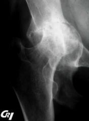 Douleurs inflammatoires de la hanche droite chez une femme de 48 ans, souffrant de PR évoluée des 2 mains, des 2 pieds.
Décrivez ce que vous voyez sur ce cliché.