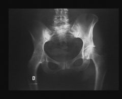 Gonalgie droite chez une femme de 45 ans.
ATCD de tuberculose articulaire de la hanche droite, dans l’enfance.