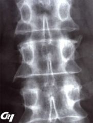 Radiographie de face du rachis lombaire d’un homme âgé de 30 ans, présentant des douleurs inflammatoires du rachis lombaire et des douleurs de même rythme de la symphyse pubienne.