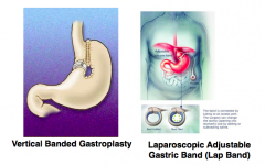 Restrictive procedures:
- Vertical banded gastroplasty - no longer used
- Laparoscopic adjustable gastric band (lap band)
- Laparoscopic sleeve gastrectomy