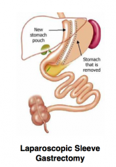 Divide stomach to leave a smaller pouch
- Leave it with one major artery (instead of the five)
- Remove 75-80% of stomach
- Keep pylorus (shouldn't have dumping syndrome
- Limits total amount of food