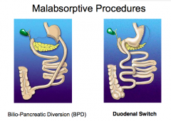 - Bilio-pancreatic diversion (BPD)
- Duodenal switch (also restrictive by removing part of stomach, and connect stomach to ileum, no pancreatic enzymes or bile to digest fat until very close to colon)