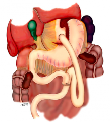Roux-en-Y Gastric bypass:
- Divide stomach into two
- Divide small intestine into two and one limb comes up to part of the stomach
- Make 15-30cc pouch and connect to 15cm roux limb