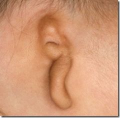 bilateral microtia/anotia (no ears)
facial nerve paralysis ipsilateral to ear
conotruncal malformations
CNS malformations
dec intelligence
thymic/parathyroid abnormalities

NO PROBLEMS IF STOPPED BY 15TH POSTMENSTRUAL DAY