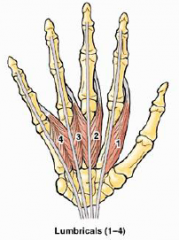 Attaches from FDP tendon to proximal phalanges of 4 fingers
 Movement: flexes MCPs and extends IPs
