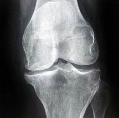 Voici un genou. Le dessin à gauche montre l’existence de l’espace articulaire par l’épaisseur des cartilages. Ce qui objective le pincement articulaire par usure cartilagineuse. Et comme dit en cours, l’atteinte arthrosique sera longtemp...