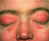 A heliotrope periorbital rash.  Sometimes a generalized maculopapular rash may appear