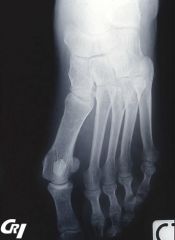 Femme de 28 ans se plaignant de douleurs inflammatoires des 2 mains, depuis  18 mois, ayant fait évoquer une PR.  Depuis 2 mois, elle décrit aussi des douleurs des pieds, de même rythme.
Selon ses clichés radiographiques de l’un de ses pied...