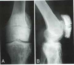 Douleurs du genou, antérieures principalement, et mécaniques.
Majoration des ces dernières après une chute sur les genoux, il y a 2 jours.