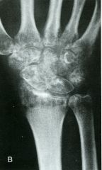 Douleurs du poignet droit apparues 10 jours après l’ablation du plâtre initialement posé pour fracture du coude droit.