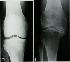 Homme de 50 ans. Évolution d’une douleur mécanique du genou droit en 1 an.