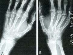 Douleurs inflammatoires des mains chez un sujet jeune, 17 ans, associées à d’autres douleurs des pieds et des genoux, de même rythme, ainsi qu’à une AEG au moment des crises. 
Le cliché B a été effectué 6 mois après le A.