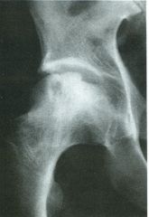 Douleurs mécaniques de la hanche droite, dans les suites d’un traitement par corticoïdes, d’une durée de 6 semaines, pour lupus érythémateux disséminé.