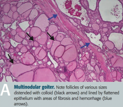Toxic Multinodular Goiter
- Follicles of various sizes distended with colloid (black arrows)
- Follicles are lined by flattened epithelium with areas of fibrosis and hemorrhage (blue arrows)
- Nodules are rarely malignant