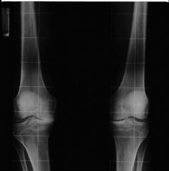 Radiographies des membres inférieurs en charge. 
Douleurs mécaniques du genou droit principalement du compartiment interne.