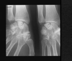 Homme de 64 ans souffrant de douleurs mécaniques des poignets, principalement sur le bord  radial de la main.
Souffre également d’une chondrocalcinose des 2 genoux, depuis 2 à 3 ans.