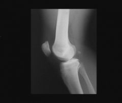 Douleurs mécaniques du genou chez un homme de 23 ans, ancien sportif intensif. Ces douleurs ont débuté à la fin de l’adolescence et sont centrés sur la face antérieure du genou