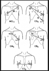 A. Lead I, RA lead below the clavicle, LA lead in the V5 position, LL at the hip

A or C
A for anterior ischaemia (best answer)
C for inferior ischaemia