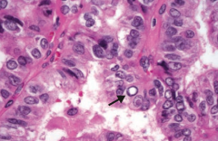 If you see this on a sample of the thyroid, what diagnosis do you need to think of?