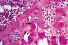 Medullary Carcinoma of the thyroid
- Solid sheets of cells with amyloid deposition (arrow)
- Amyloid stroma