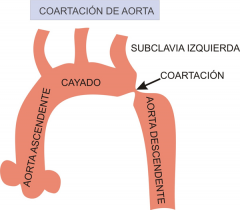 -Sindrome de turner
- Se asocia a : PCA, CIV, aorta bivalva y anomalias de la valvula mitral
- Es mas común en la aorta descendente