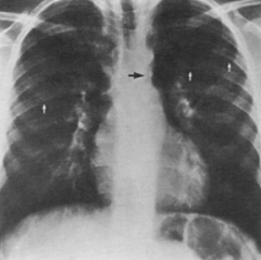 -Signos de edema pulmonar y cardiomegalia
- Signo de Roesstel-nuescas costales(como costillas comidas)- se da x la erosion de la dilatacion de los de los vasos intercostales
- Signo del 3 invertido