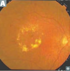 Small vessel disease due to diffuse thickening of basement membrane via non-enzymatic glycosylation:
- Retinopathy (picture): hemorrhage, exudates, microaneurysms, vessel proliferation
- Glaucoma