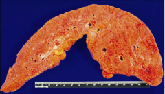 What is this end-stage of liver disease?