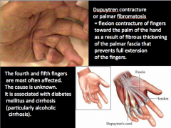 What two things is Dupuytren contracture (palmar fibromatosis) associated with?