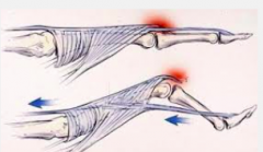 Extensor hoods 
• Triangular shaped covers for the extensor tendons of the foot 
 • Apex (distal phalanx), fans out over the middle/proximal phalanx,
wraps around the metatarsalphalangeal joint attaching to the deep
transverse metatarsal ...