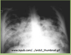 1.) PaO2/FiO2 < 200 (<300 means acute lung injury)
2.) Bilateral alveolar infiltrates on CXR
3.) PCWP is <18 (means pulmonary edema is non 
cardiogenic)