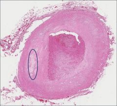 What pathology is shown in the circle?