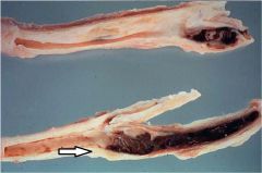 What is the pathology shown at the tip of the arrow?