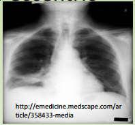 – If pt has risk factors (smoker, old), If >3cm, if eccentric 
calcification
• Do open lung bx and remove the nodule