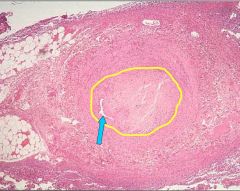 The yellow circle shows organization of a thrombus.

The blue arrow is pointing to recanalization.  Recanalization is occurs as part of organization.