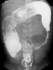 stool that is palpable throughout the abdomen with an empty rectum on exam is suggestive of this disease
abdominal xray may show stool and distention throughout the proximal abdomen with no gas or feces in the rectum
an anal manometry that demonst...