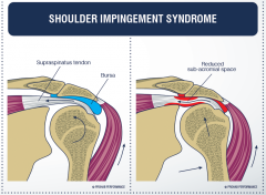 Compression of the rotator cuff tendon between the acromion of the scapula and the humerus. 


This is typically due to inflammation of the subacromial bursa which often occurs after exercise in middle age individuals.