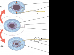 Midriasis is caused by postganglionic sympathetic nerves that stimulate the dilator pupil muscle (Long cillary nerve) 

