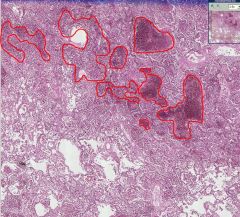 Lung (alveoli)

Hemorrhage into the alveolar tissue.  The bottom area is normal (alveoli are empty).