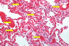 What pathology are the yellow arrows pointing to?

What is a likely possible cause of this pathology?