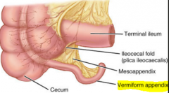 Below ileocecal valve
-Appendicitis-> inflamed appendix