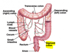 -peritoneal suspended by the sigmoid mesentery
-ends at S3 vertebra
-Diverticulosis can occur
