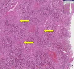 What process has occurred in the areas indicated by the yellow arrows?

Why does this process occur?

What term is given to this pathology?