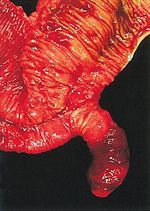 1. vestigial remnant of the omphalomesenteric duct that is the most common anomaly of the GI tract2. 2 years of age