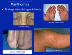 tendon xanthomas is indicative of familial hyperlipidemia