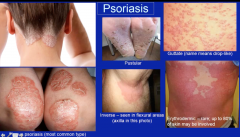 plaque psoriasis occurs over extensor surfaces