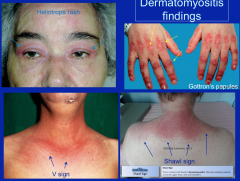 Gottron's papules = over MCP or PIP joints 
mechanics hands = subtype of dermatomyositis