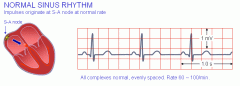 Rate: 60-100 bpm
Rhythm: regular
P waves before QRS: yes
PR interval: 3-5 small squares
QRS complexes look alike: yes