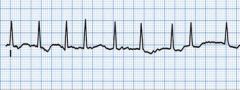 Rate: 350-400 bpm
Rhythm: irregular
P waves before QRS: no
PR interval: NA
QRS complexes look alike: yes